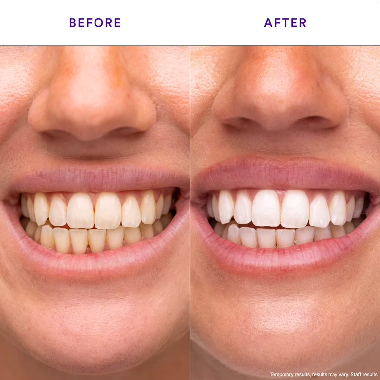 NoVixor Teeth Whitening Strips