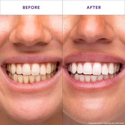 NoVixor Teeth Whitening Strips